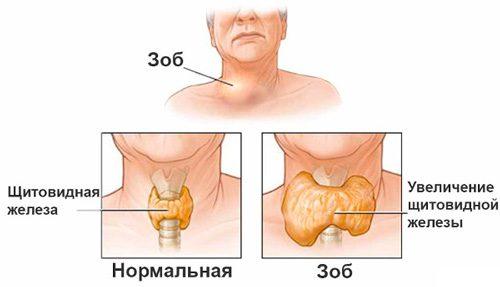 25 травня – Всесвітній день щитоподібної залози (World Thyroid Day)
