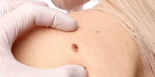 13 травня - Всесвітній День МЕЛАНОМИ